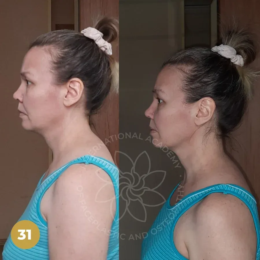 Women’s Body Secrets member before-and-after example: Head & neck posture