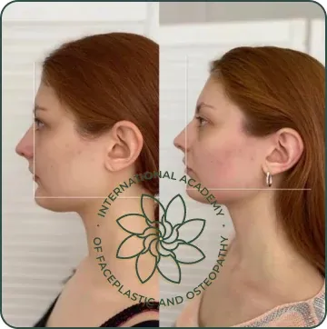Chin became more defined and projected