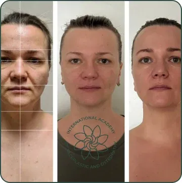 Strong tension in the lower face has disappeared