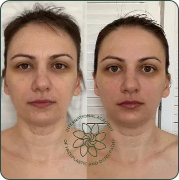 Nasolabial folds became less pronounced