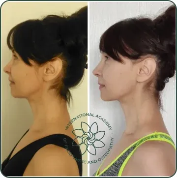 The lower face and chin were lifted