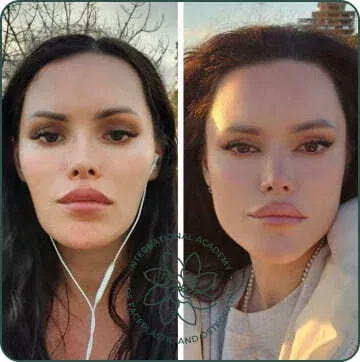 The face looks more lifted