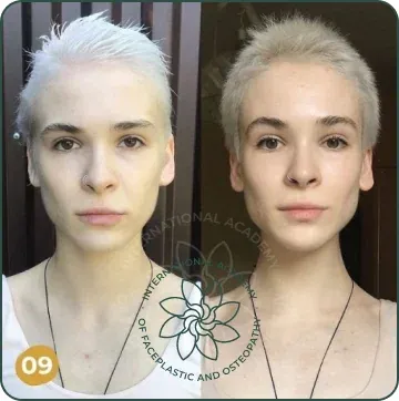 Cheekbones became more defined