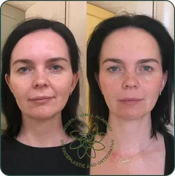 The face looks more lifted