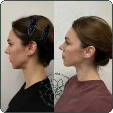 The chin has moved forward