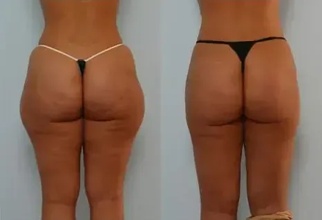 Outer thighs and glutes look smoother