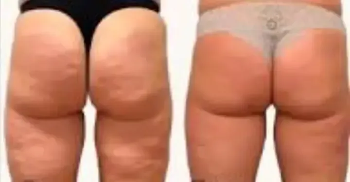 Thighs and glutes visibly smoother, dimpling reduced