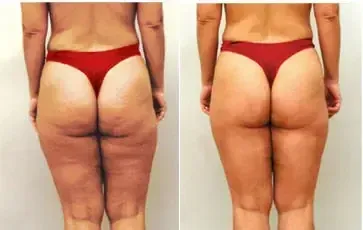 Thighs and glutes look firmer and more toned