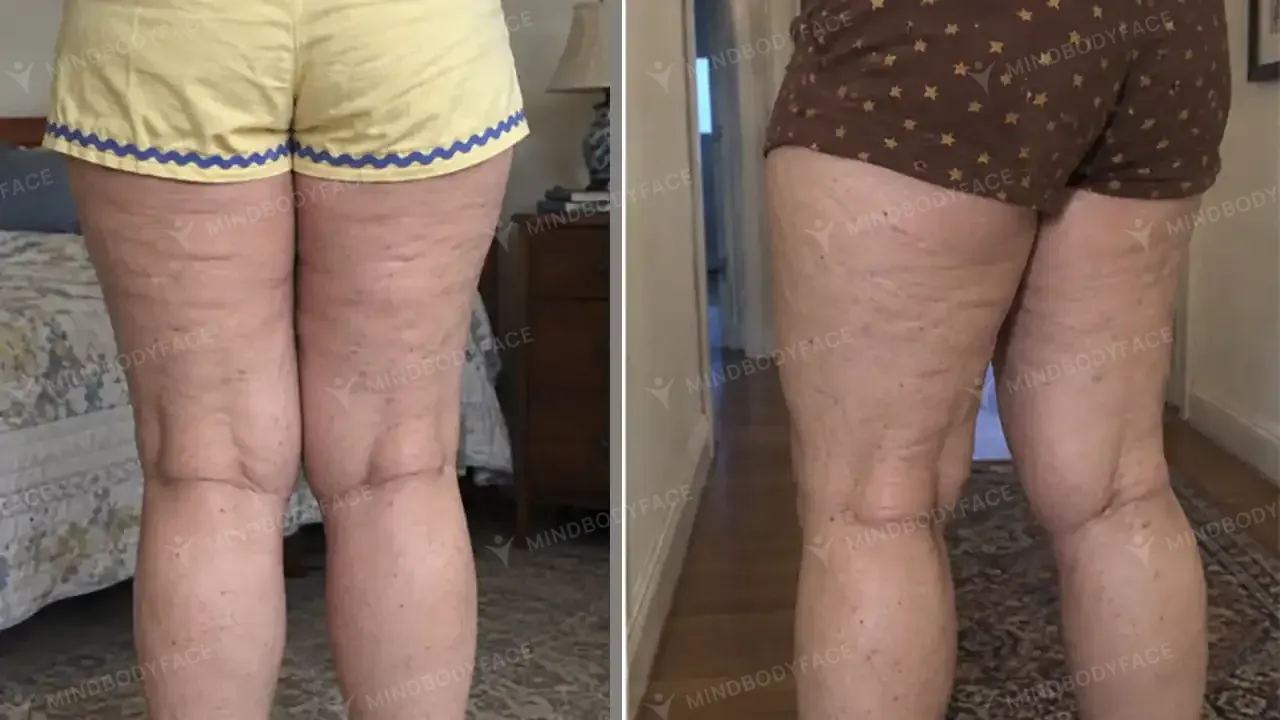 Backs of the thighs look firmer and more even