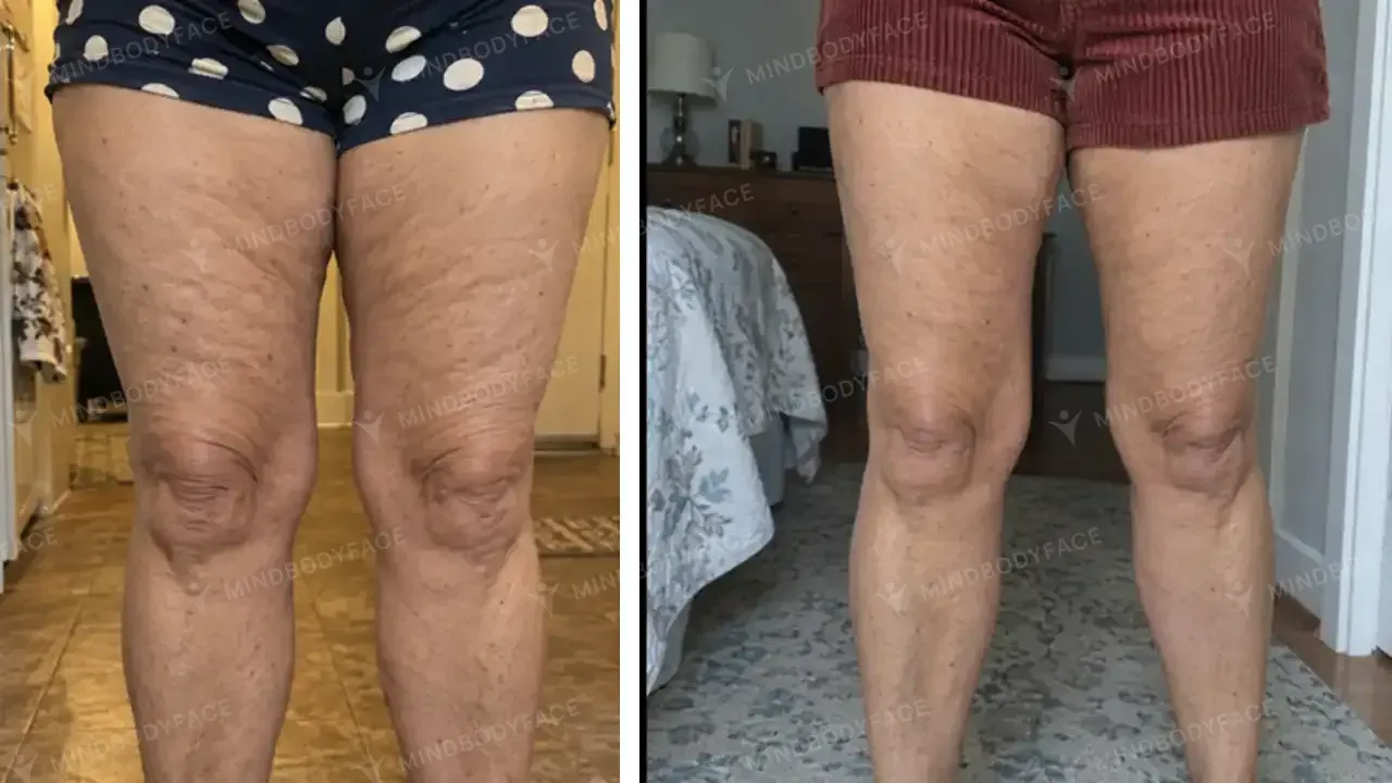 Dimpling on the thighs and above the knees reduced