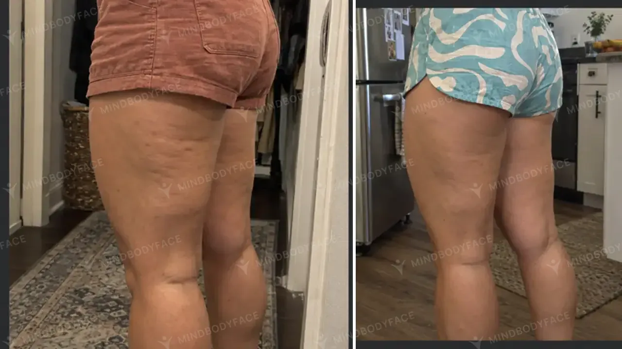 Back of the thigh looks noticeably smoother