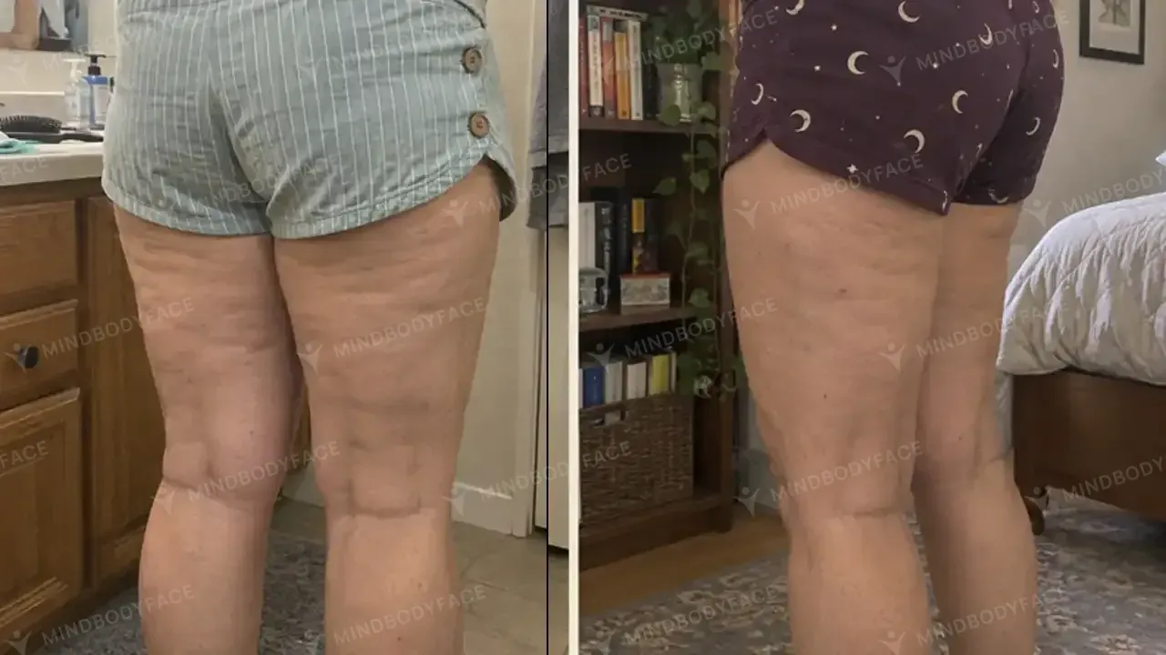 Dimples under the glutes and on the thighs softened