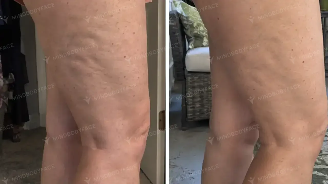 Deep dimpling on the thigh visibly reduced