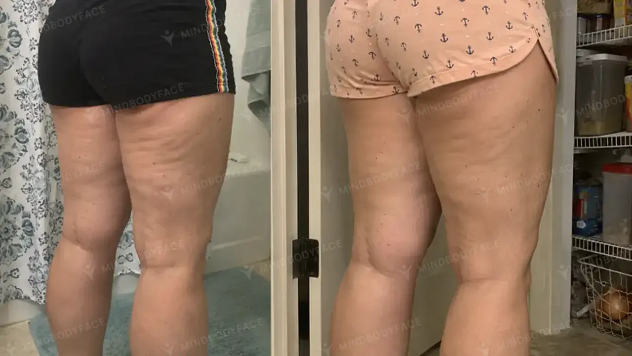 Backs of the thighs look more even and toned