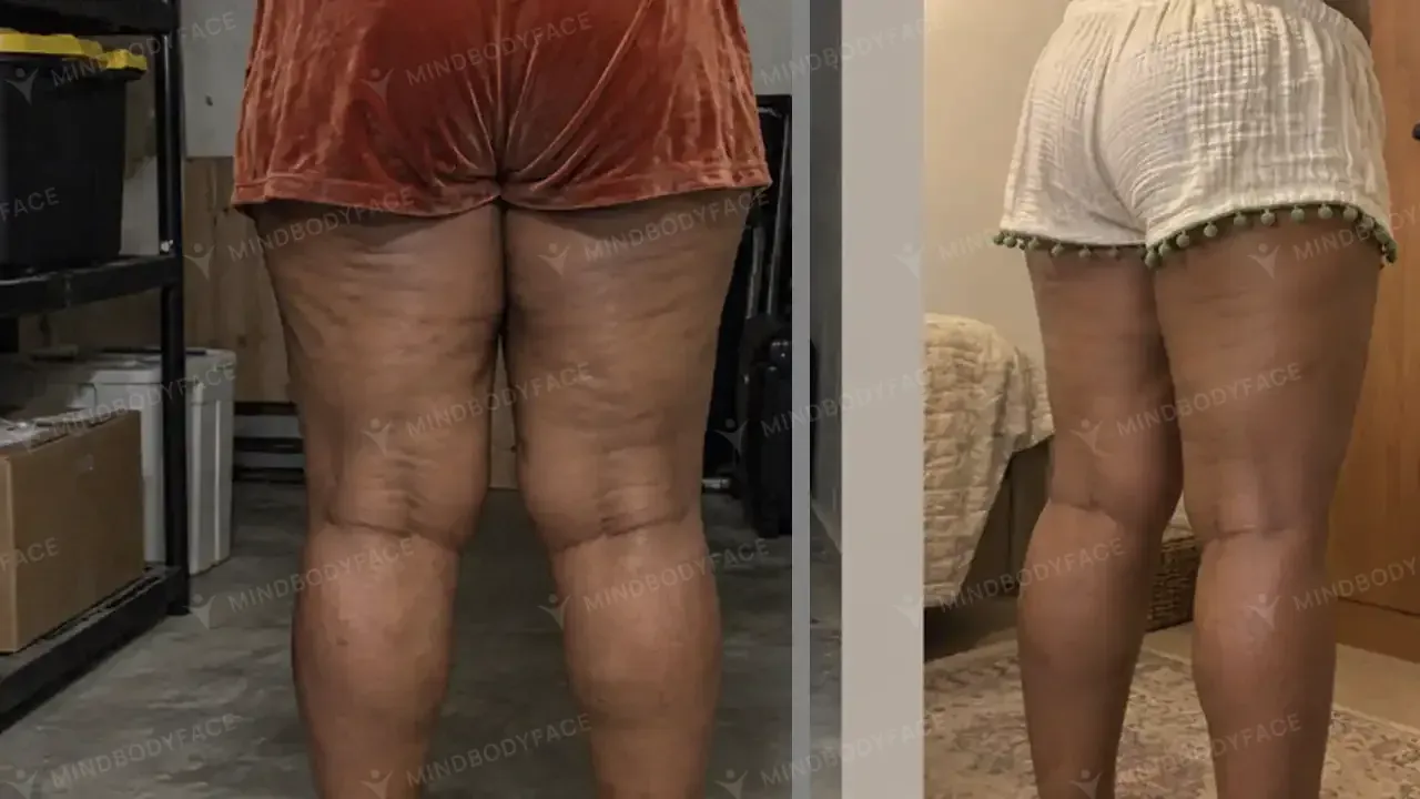 Cellulite on the backs of the thighs visibly softened