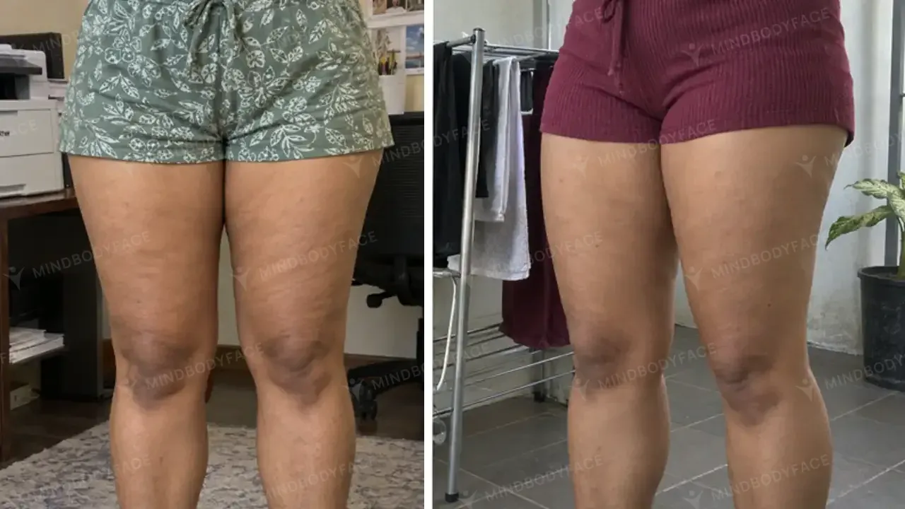 Front of the thighs looks firmer and smoother