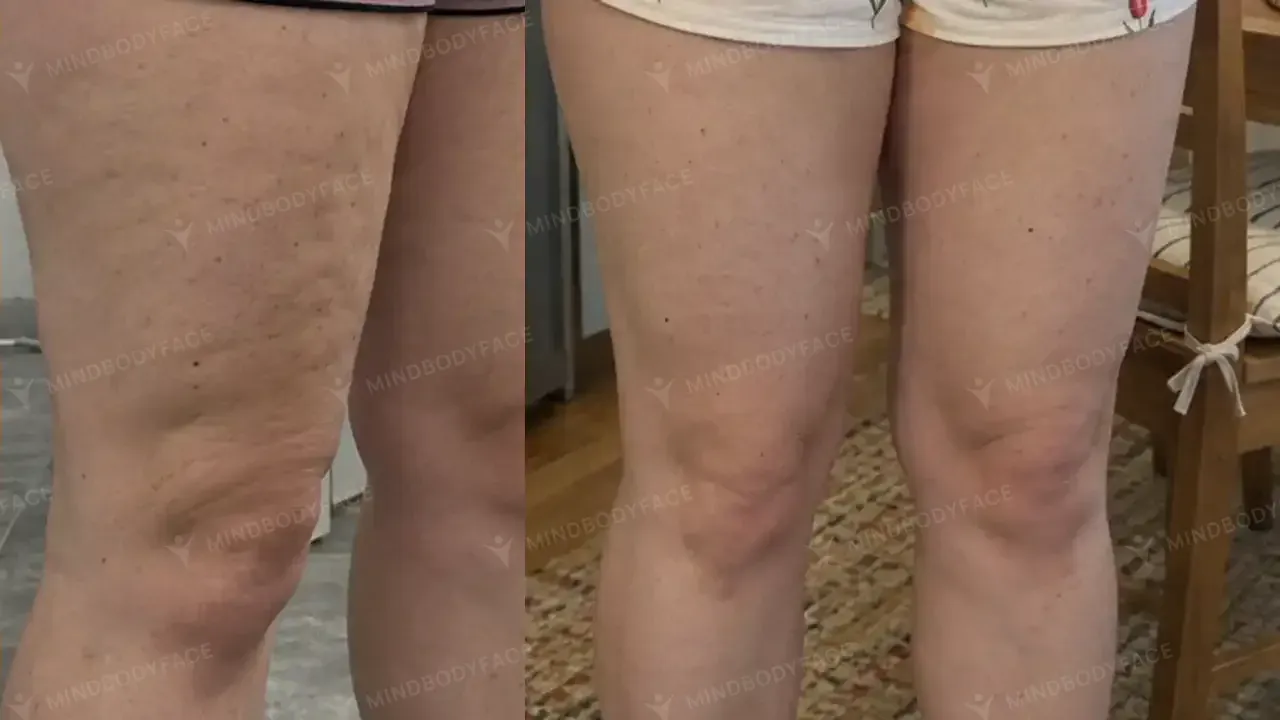 Dimpling on the backs of the thighs softened