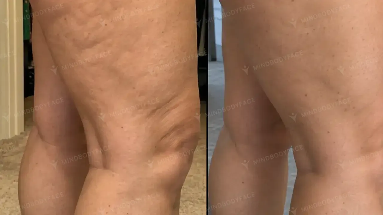 Uneven texture on the outer thigh reduced