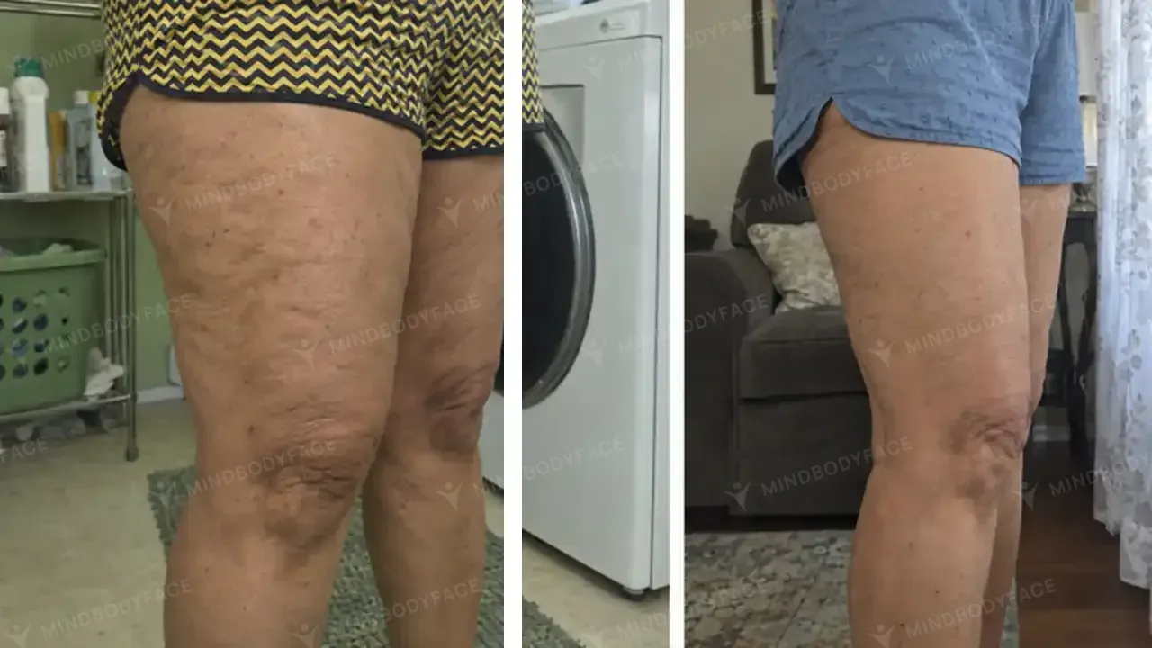 Side of the thigh looks visibly smoother