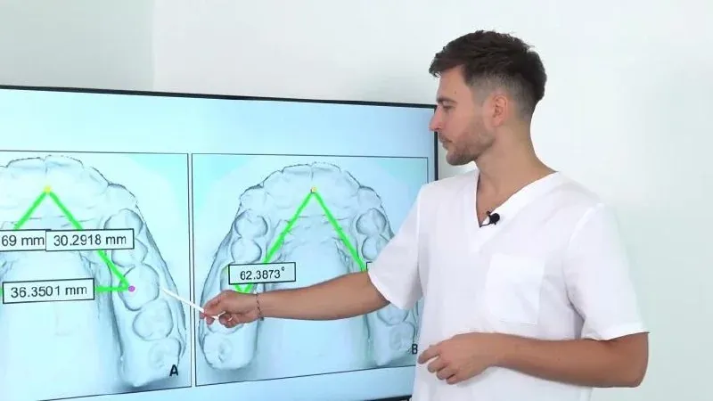 Structural diagnostics: dental arch width and upper jaw position measured on a model